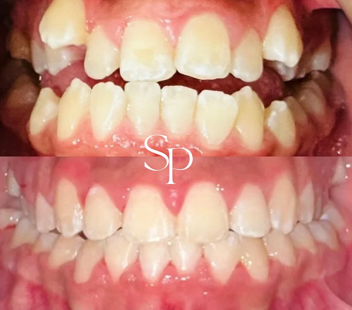 Fastbraces