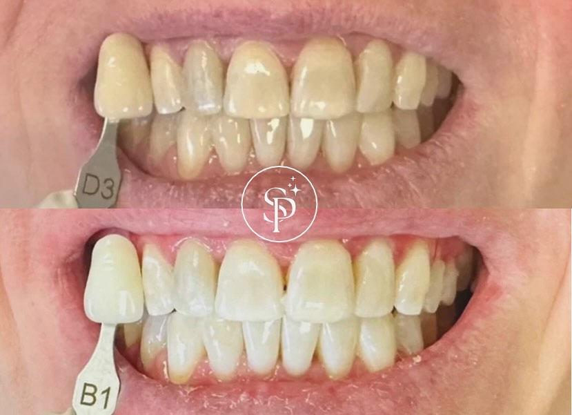 Teeth Whitening