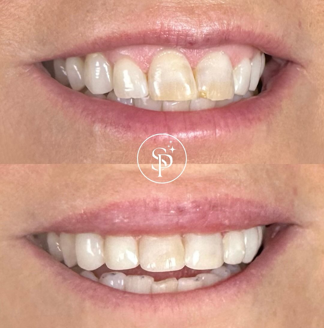 Cosmetic Bonding