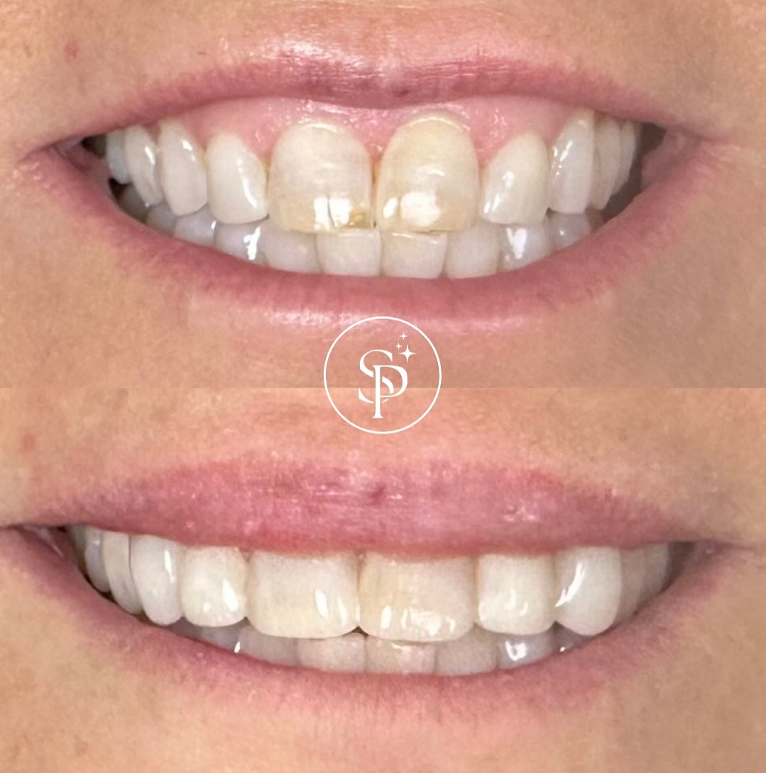 Cosmetic Bonding