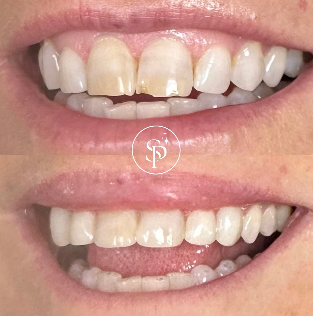 Cosmetic Bonding