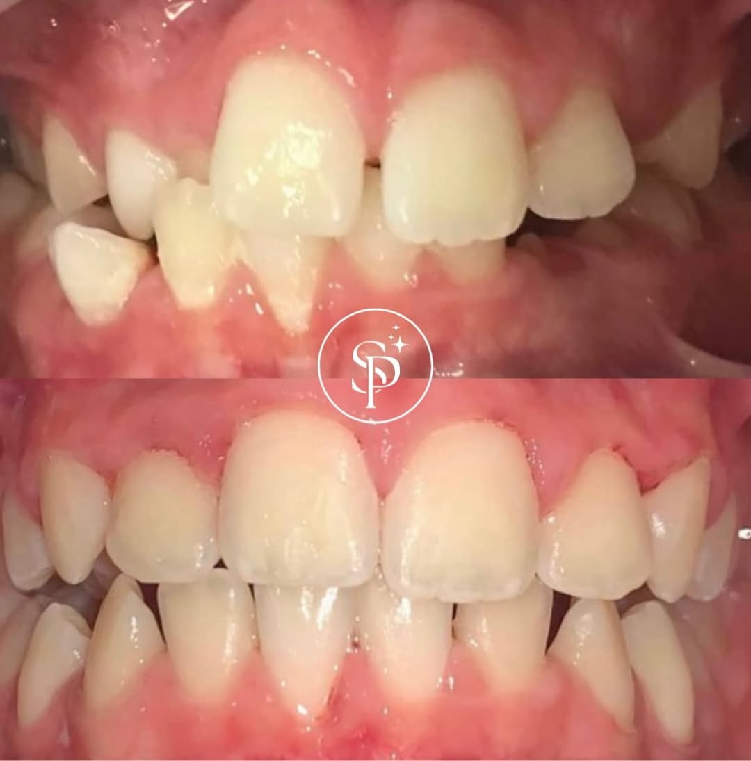 Fastbraces