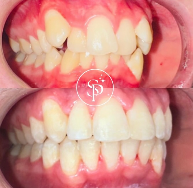 Fastbraces