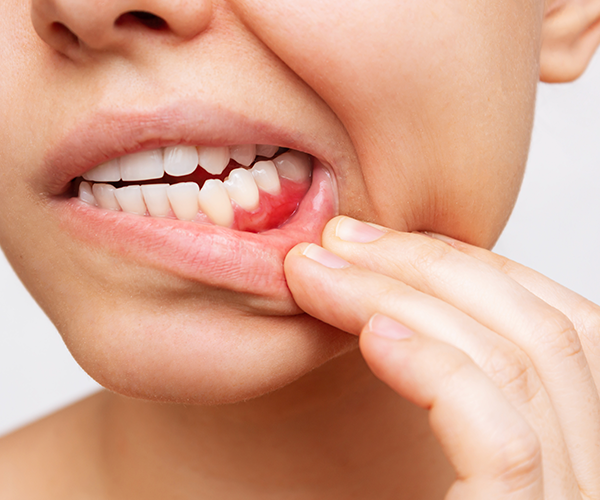 Gum Health and the Causes of Gum Disease