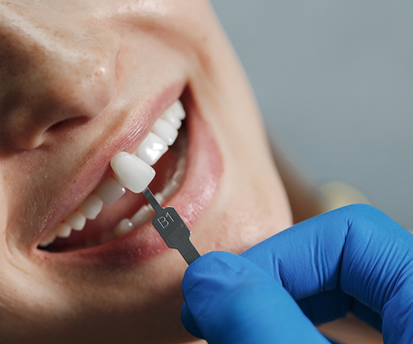 Cosmetic Bonding