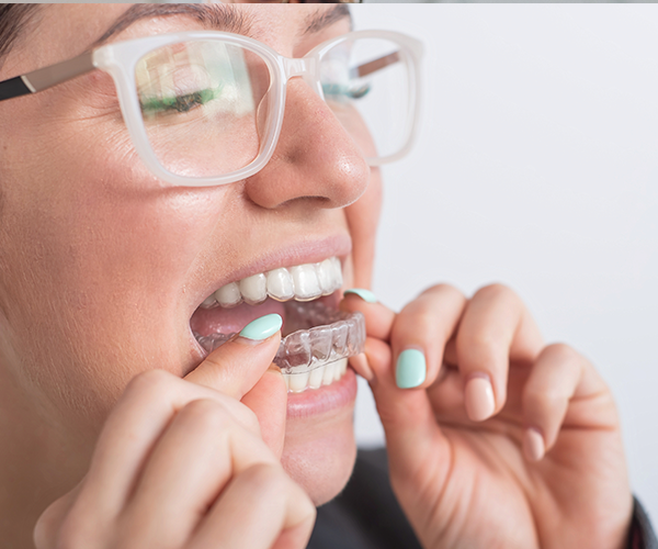 Clear Aligners - All You Need to Know