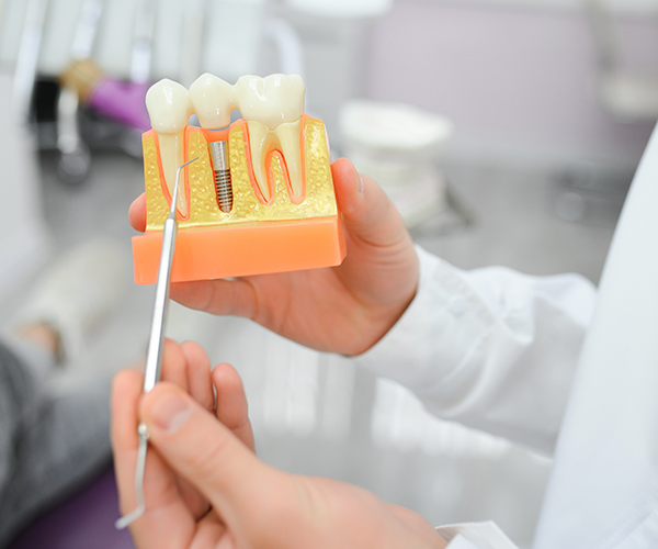 Dental Bridge vs Implant