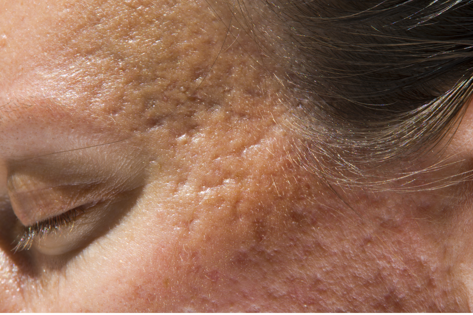 Does Retinol Help With Acne Scars?