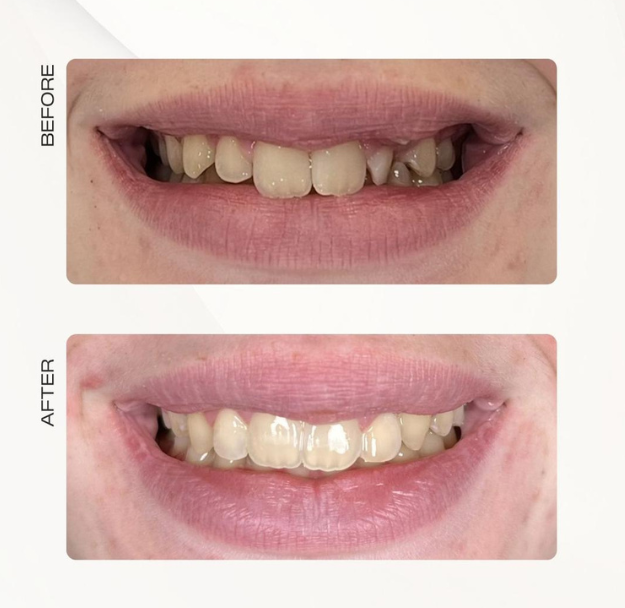 Fastbraces
