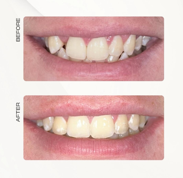 Fastbraces
