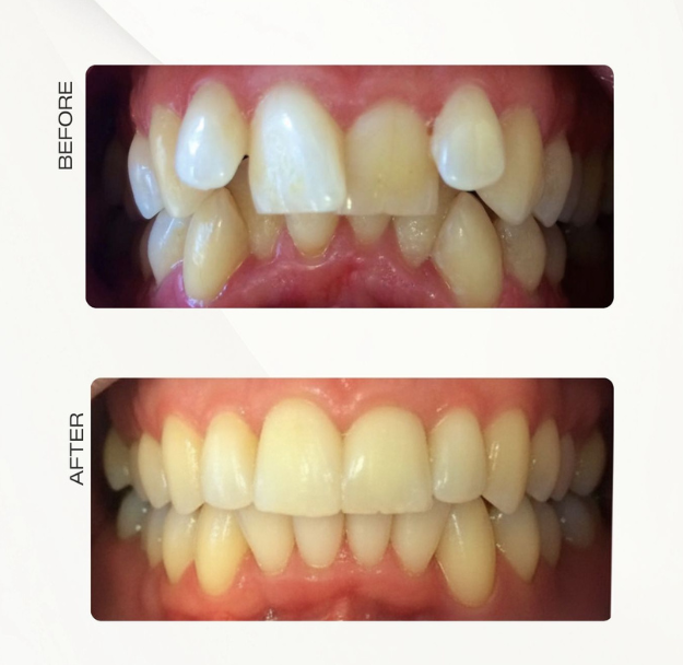 Fastbraces