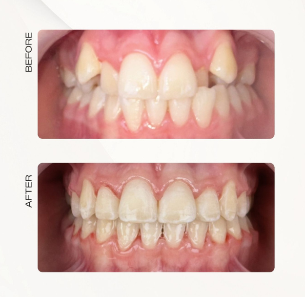 Fastbraces