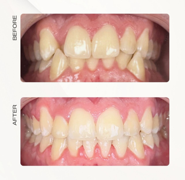 Fastbraces