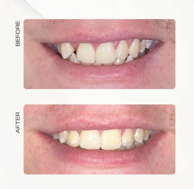 Fastbraces