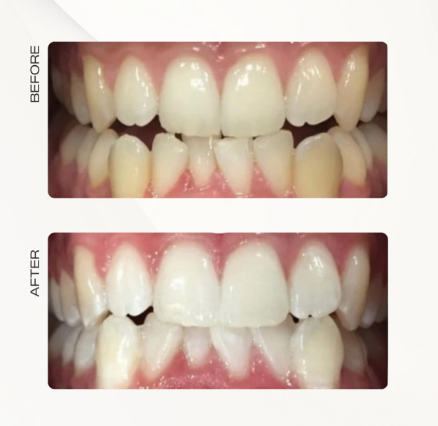 Teeth Whitening