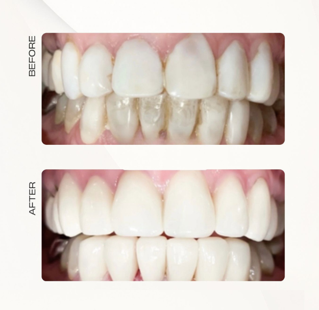 Veneers