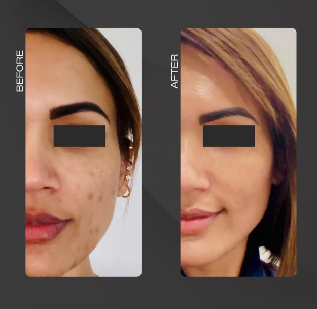 Micro Needling