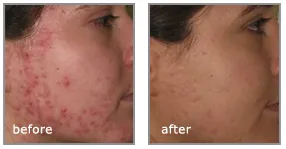 acne behandeling laser