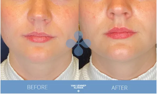 Laser Lip plumping before& after