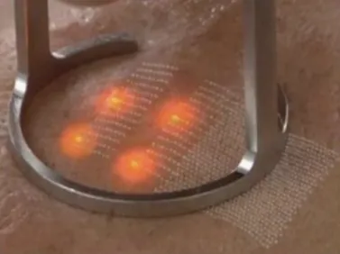 Hoe werkt Fractional laser?