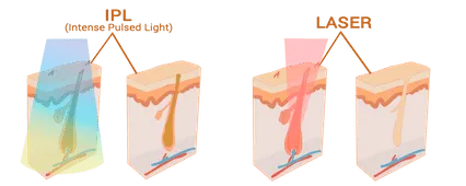 Wat is het verschil tussen een laser- en een IPL behandeling? 