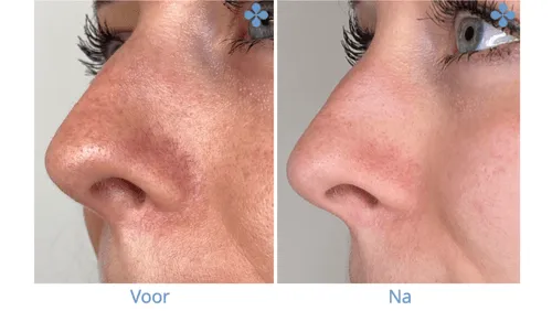 Couperose voor en na 