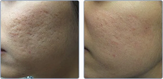 acne littekens behandelen