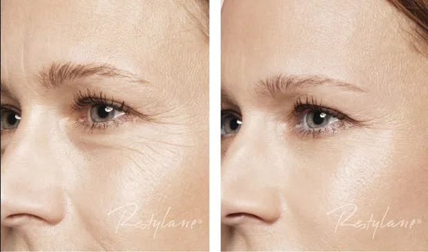 Restylane Skinbooster Voor en Na