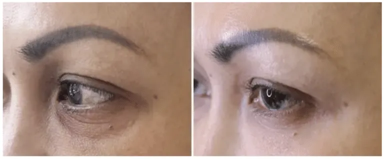 Croma PhilaRT Eye
