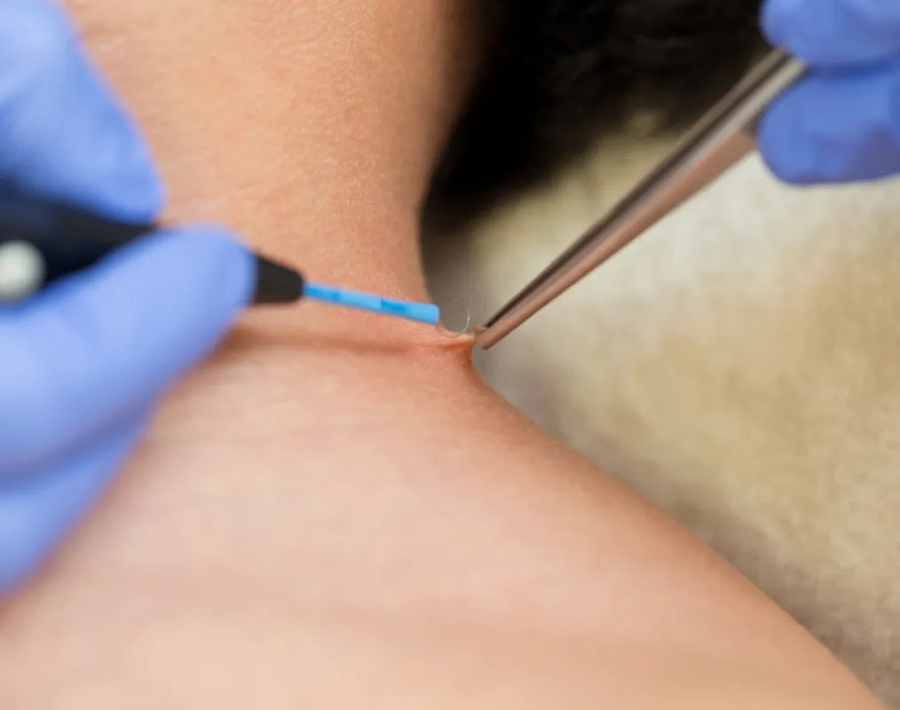 Wratjes & fibromen verwijderen