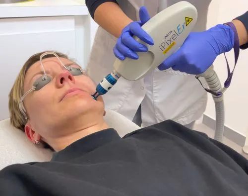 Fractional laser behandeling