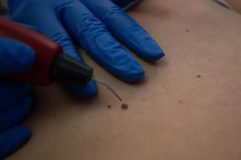 Cosmetische arts moedervlekken verwijderen