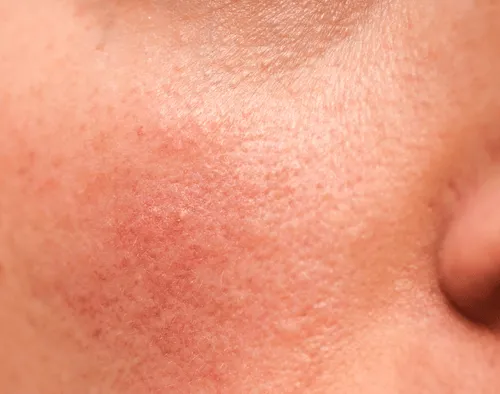 Rosacea behandeling