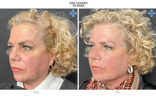 voor-na botox