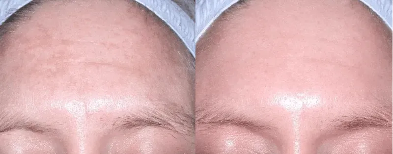 melasme before after