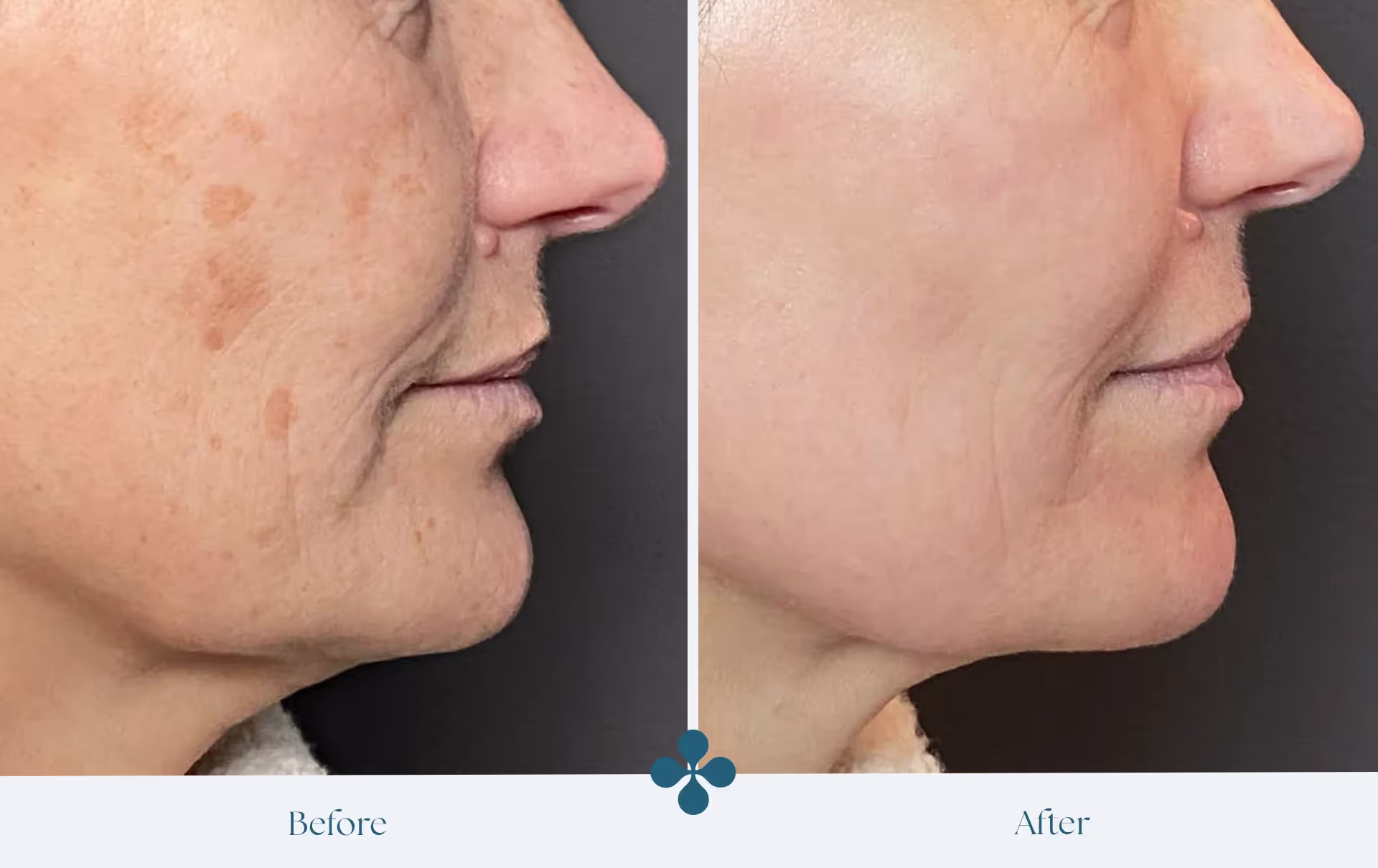Melasma voor