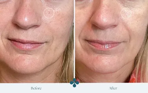 Melasma voor