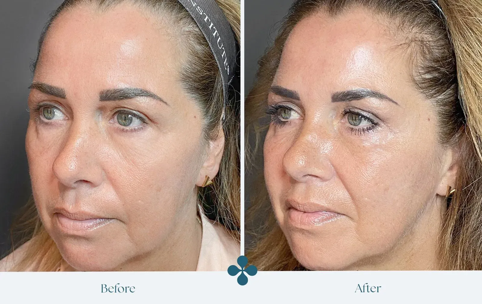 Melasma voor