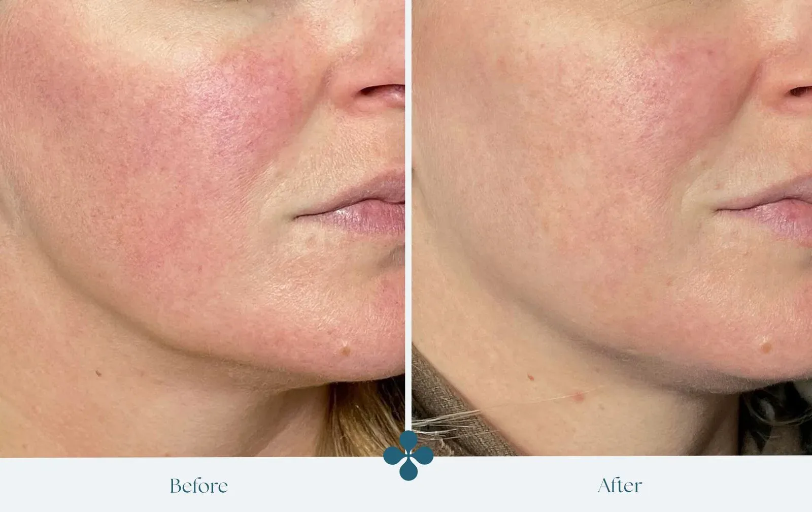 Melasma voor
