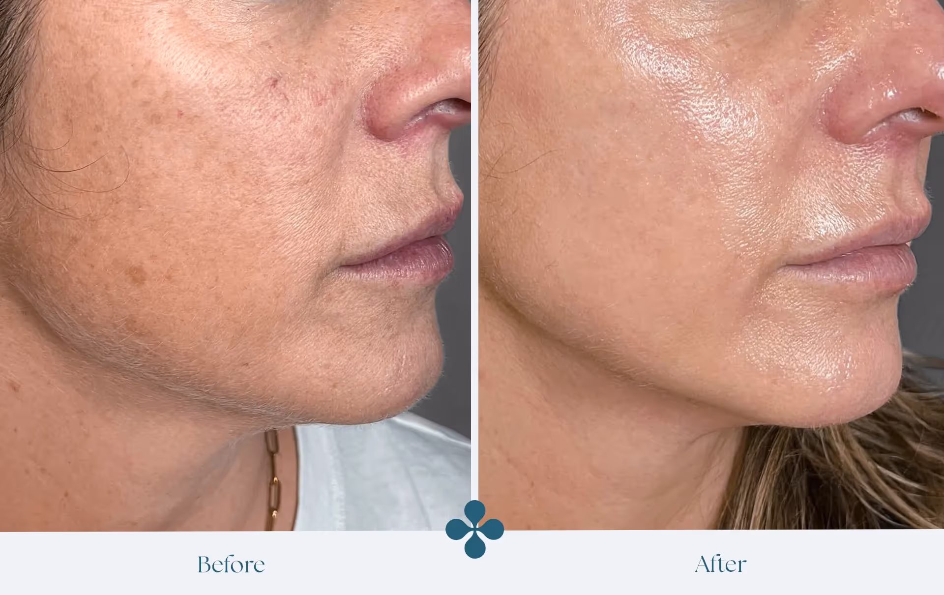 Melasma voor