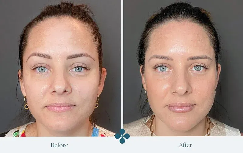 Melasma voor 
