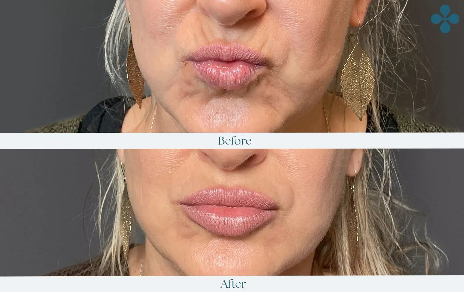 Melasma voor