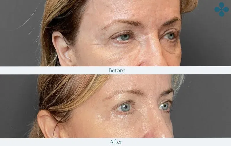Melasma voor 
