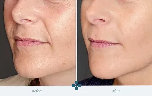 Melasma voor