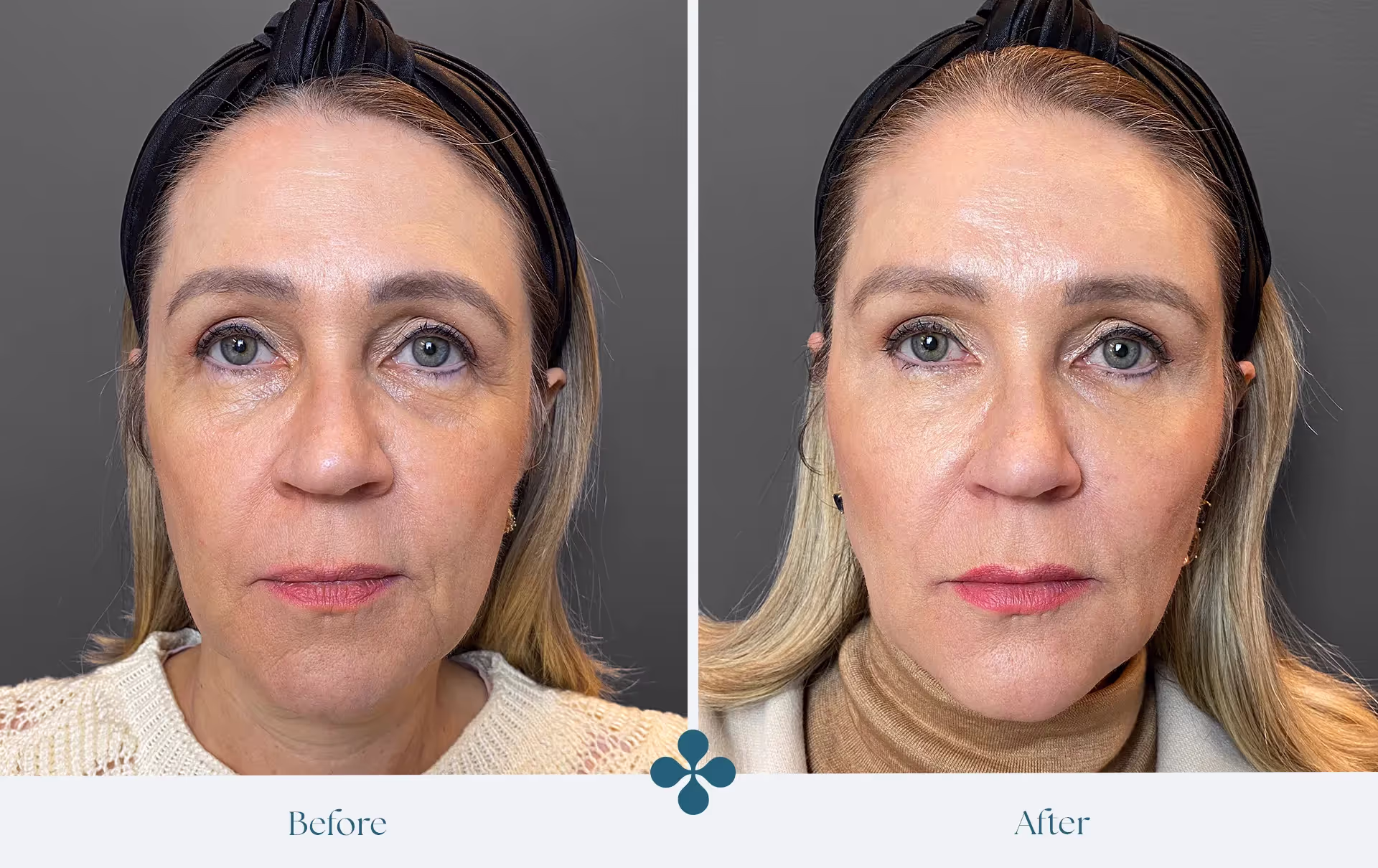 Melasma voor 