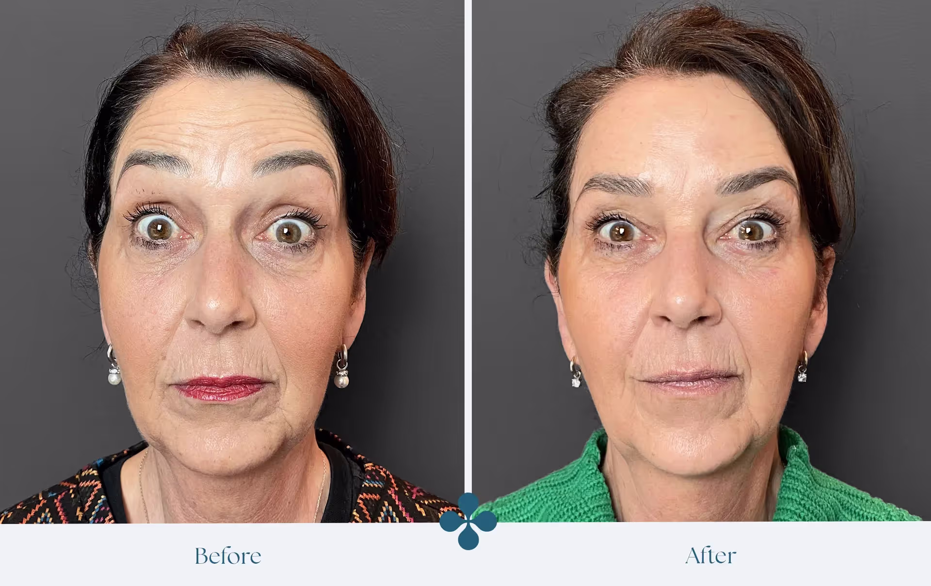 Melasma voor 