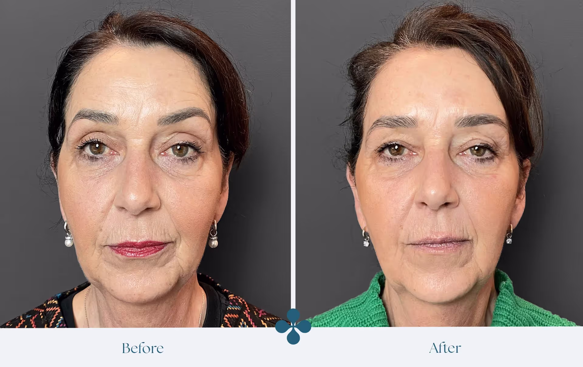 Melasma voor