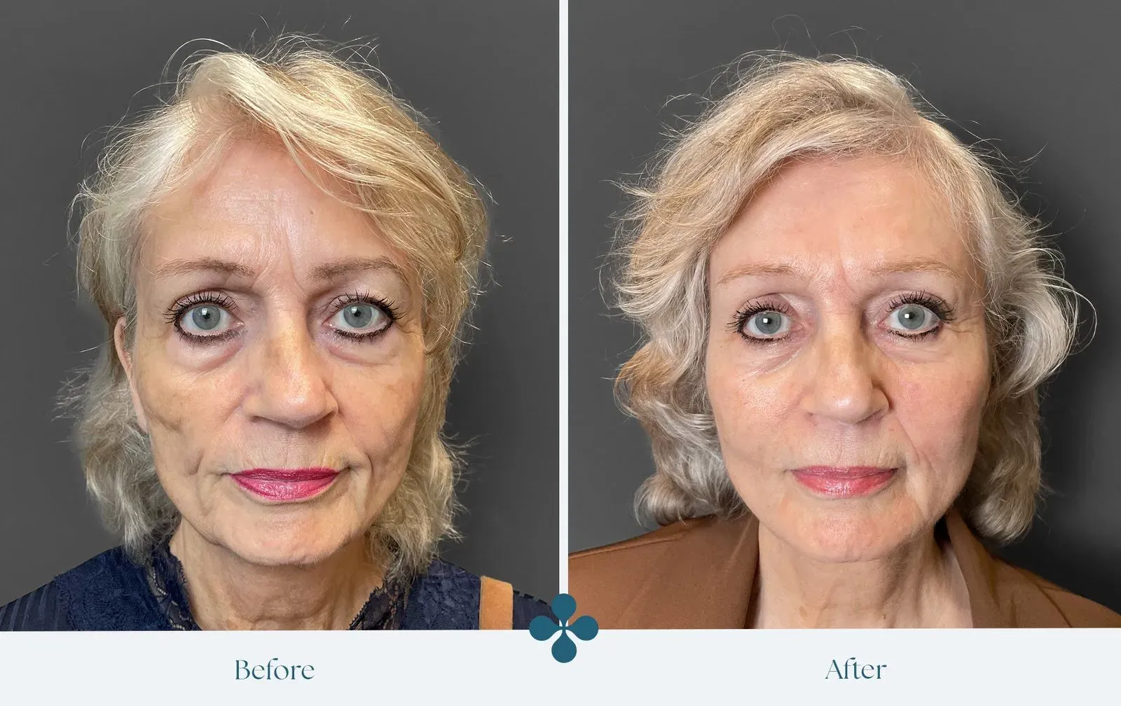 Melasma voor 