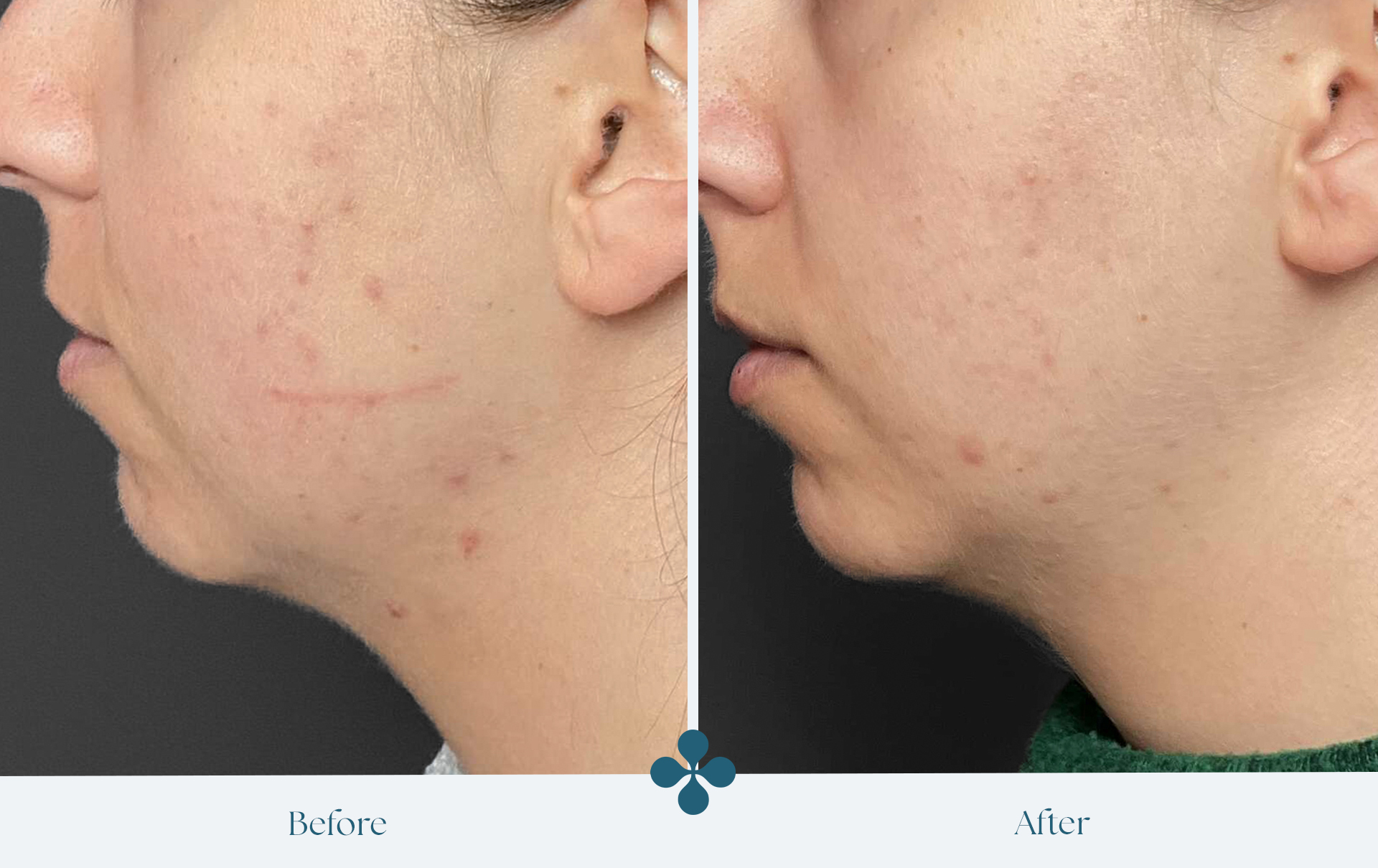 Melasma voor