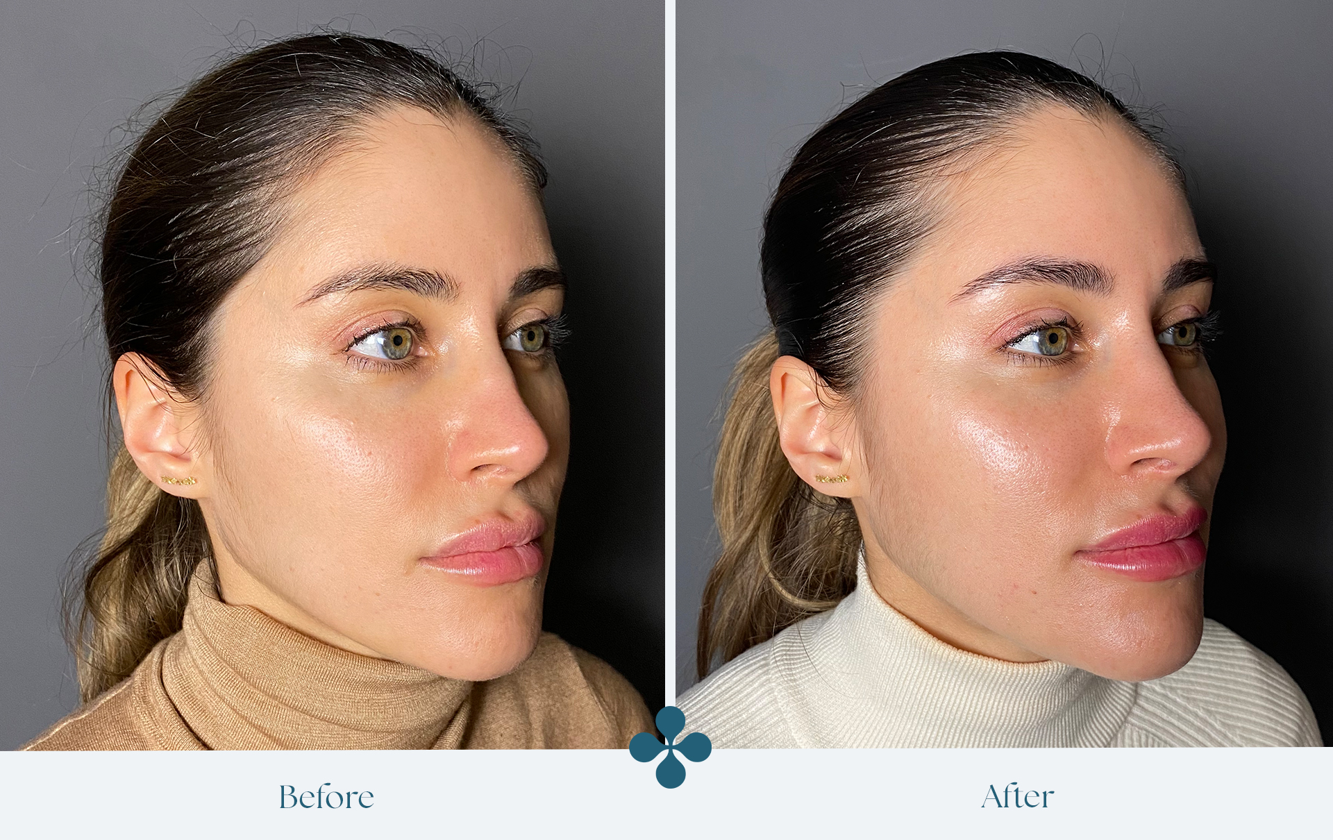 Melasma voor